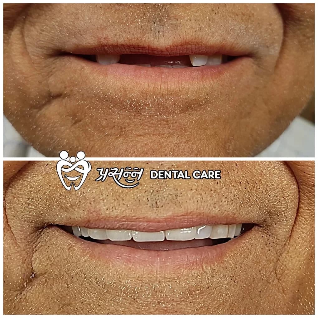 Before and after of a complete denture restoration