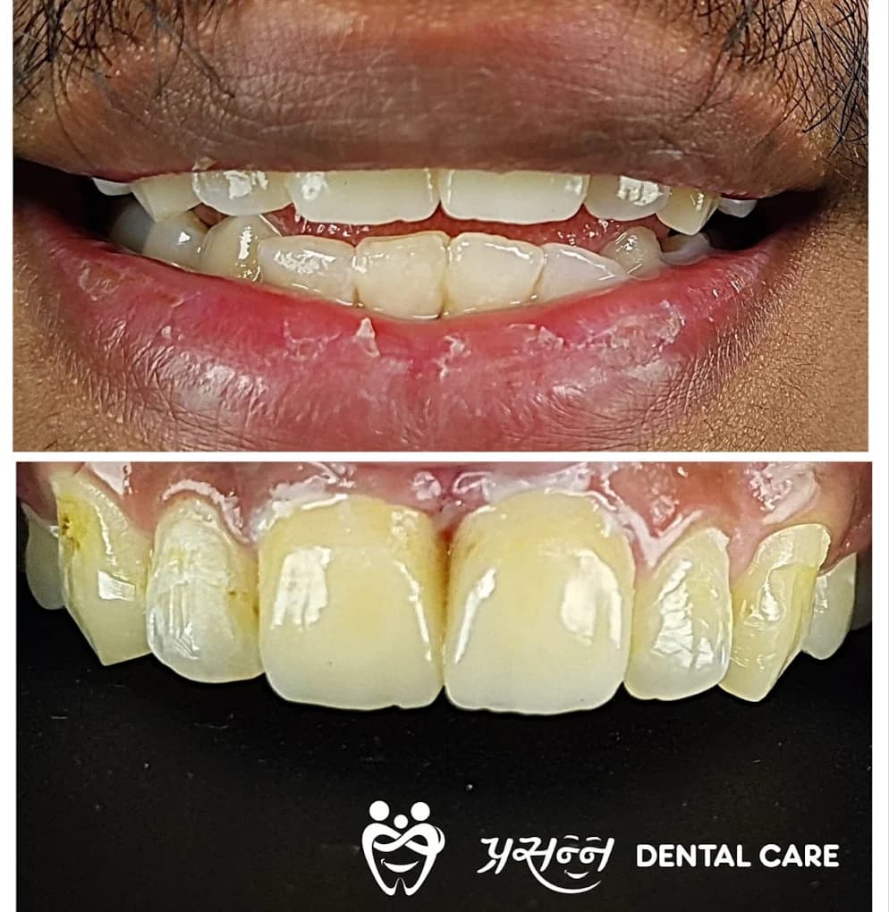 Before and after of restored front teeth