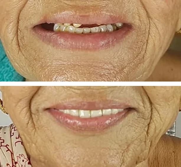 Before and after of a senior patient's rebuilt smile