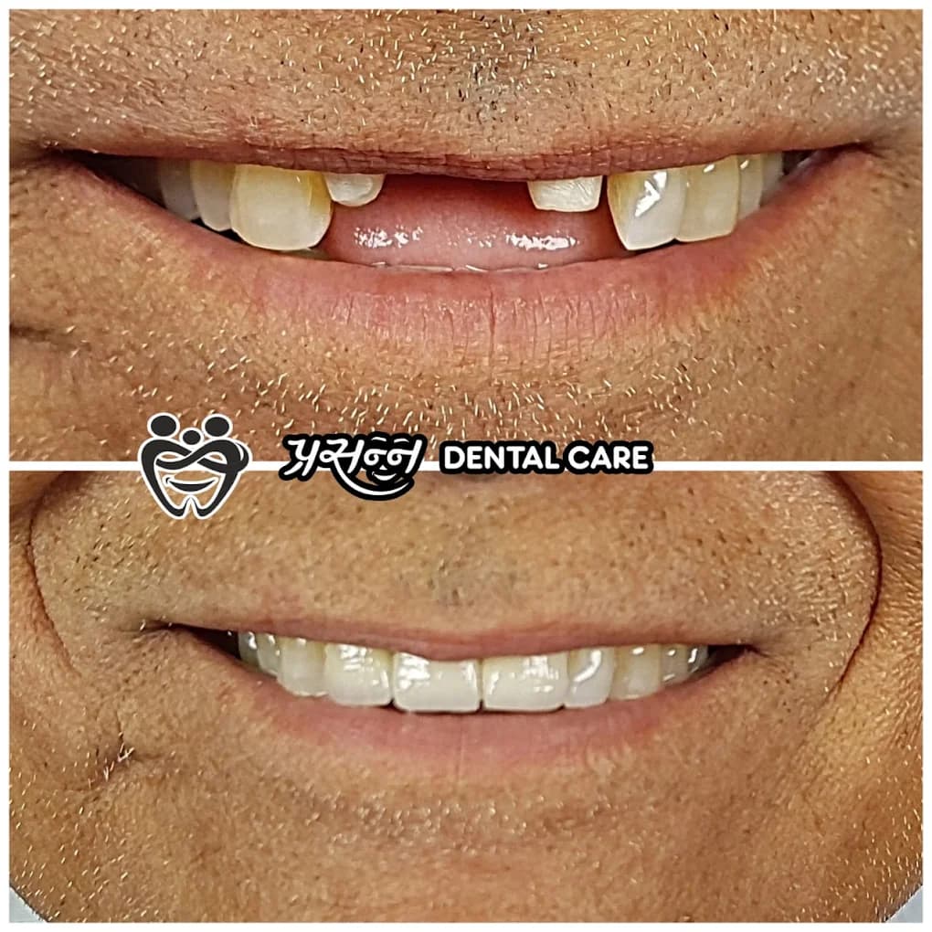 Before and after of replaced missing front teeth