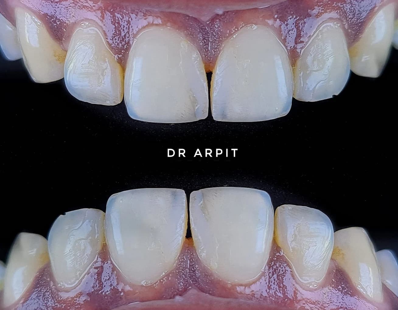 Close-up of finished veneers by Dr. Arpit
