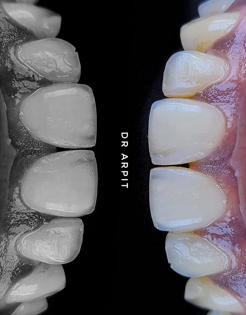 Split view of a smile before and after whitening and veneers