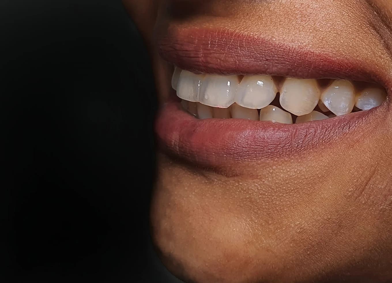 A finished smile after smile design treatment