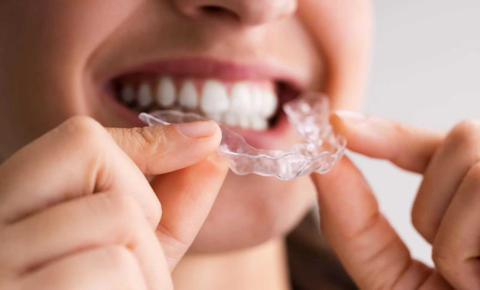 A patient placing a clear aligner tray on their teeth
