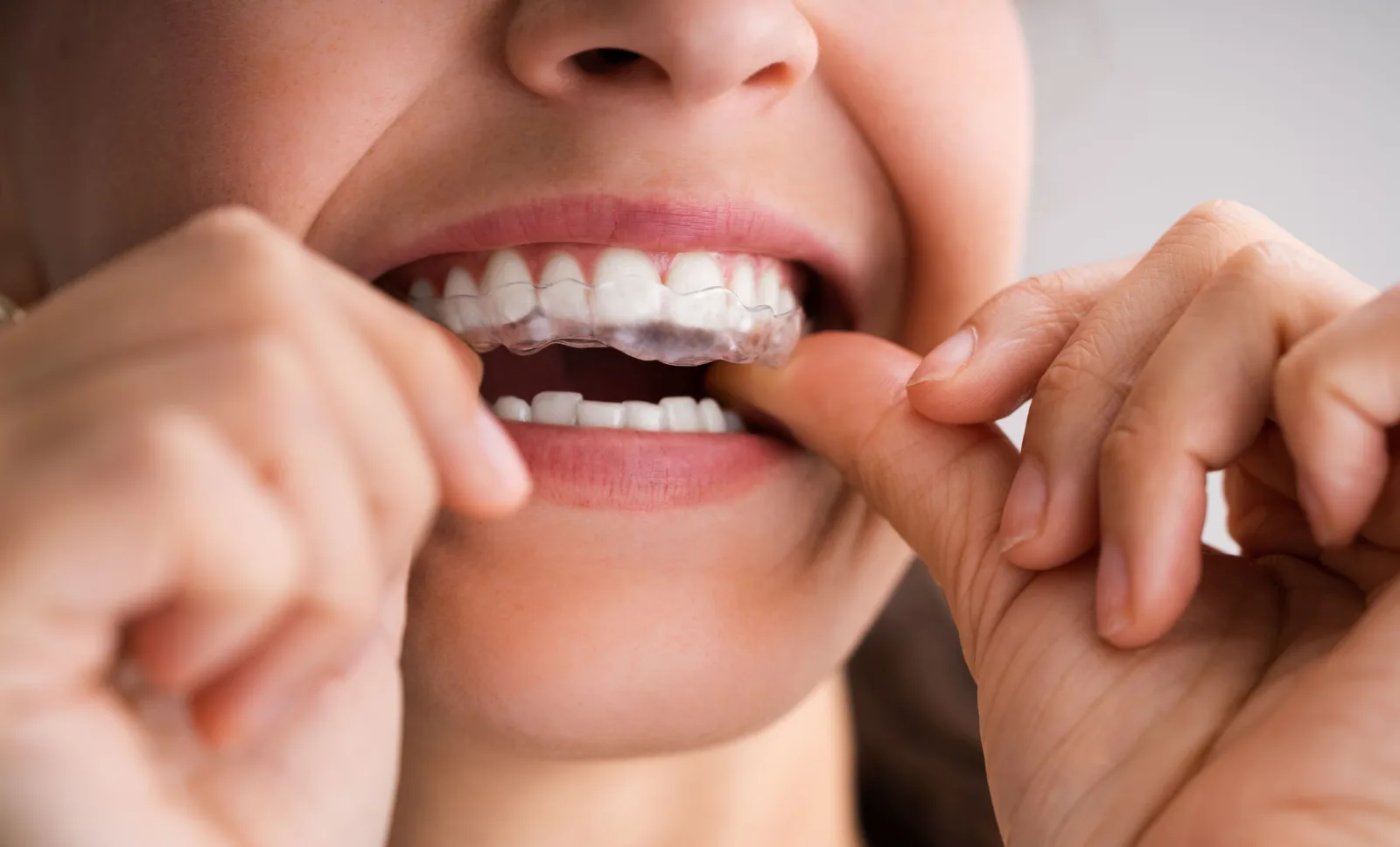 Clear Aligners