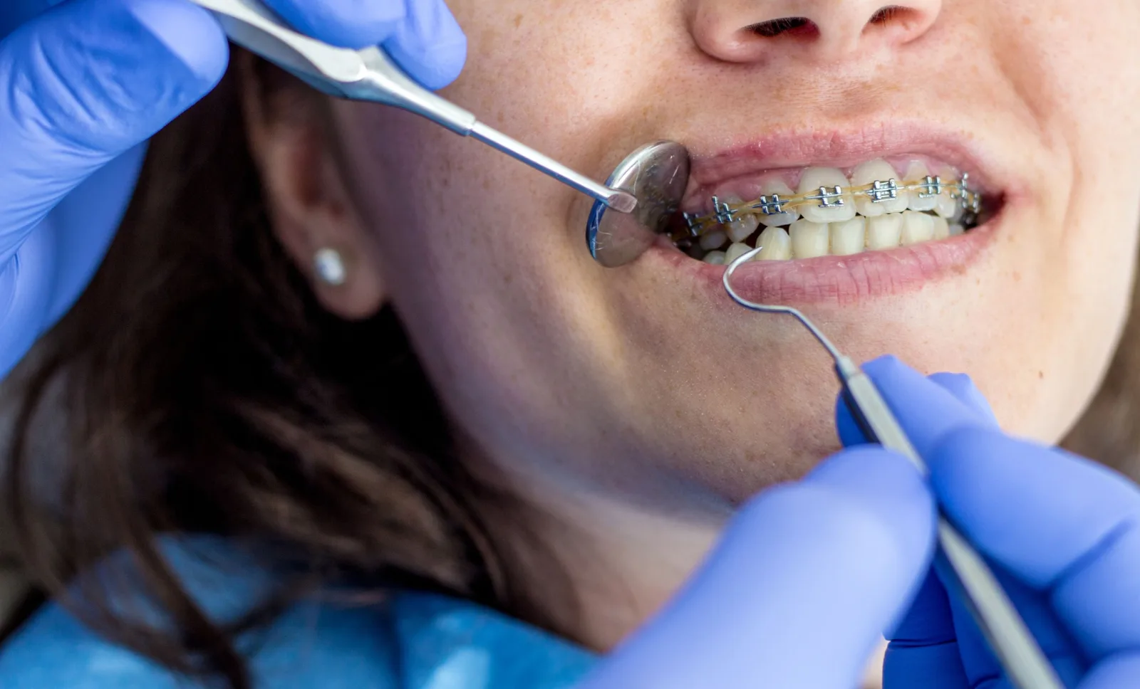 Metal Braces