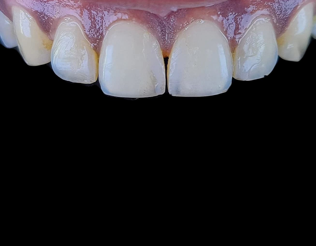 Veneers by Dr. Arpit — the bite opens as you scroll