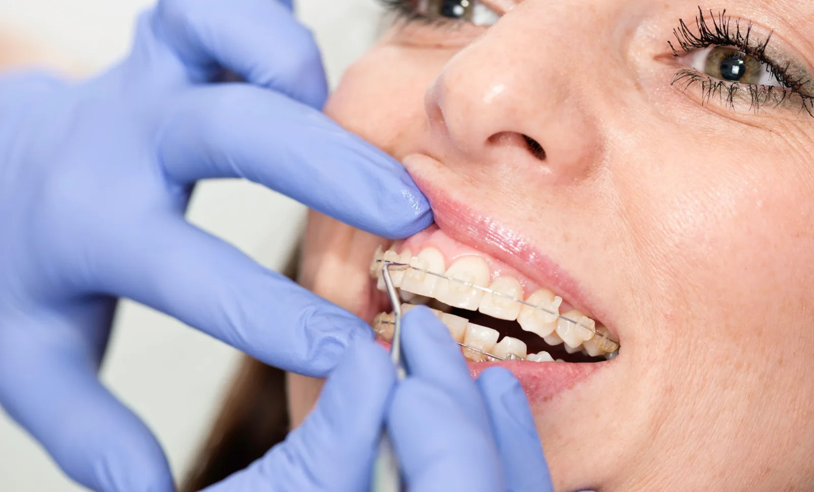 Ceramic braces being checked at a dental clinic