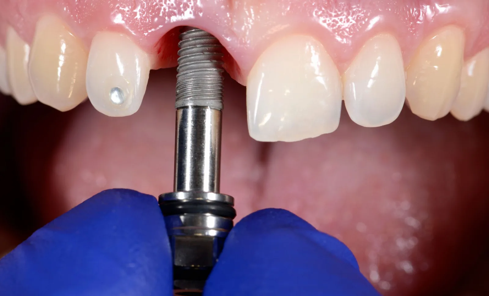 A dental implant being positioned to replace a missing front tooth