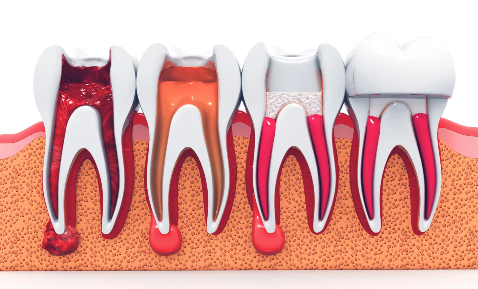 Stages of a root canal shown on cross-section tooth illustrations — from inflamed pulp to a crowned tooth